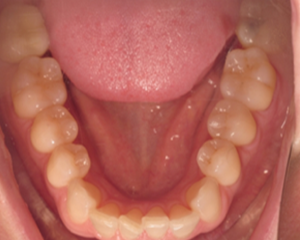 Bottom Jaw for Virtual Orthodontic Consultation