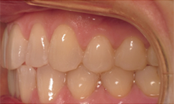 Left Bite for Virtual Orthodontic Consultation