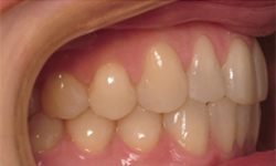 Right Bite for Virtual Orthodontic Consultation
