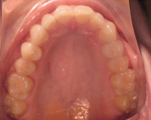 Top Jaw for Virtual Orthodontic Consultation