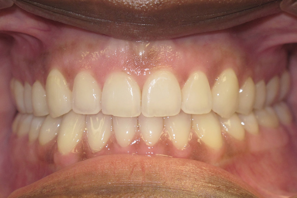 11 months of treatment with customized braces using suresmile technology - After Photo