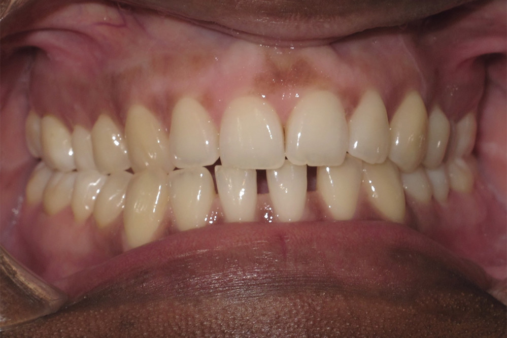 11 months of treatment with customized braces using suresmile technology