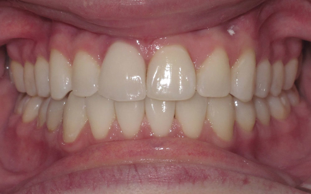Final Results using Orthopulse in Orlando FL