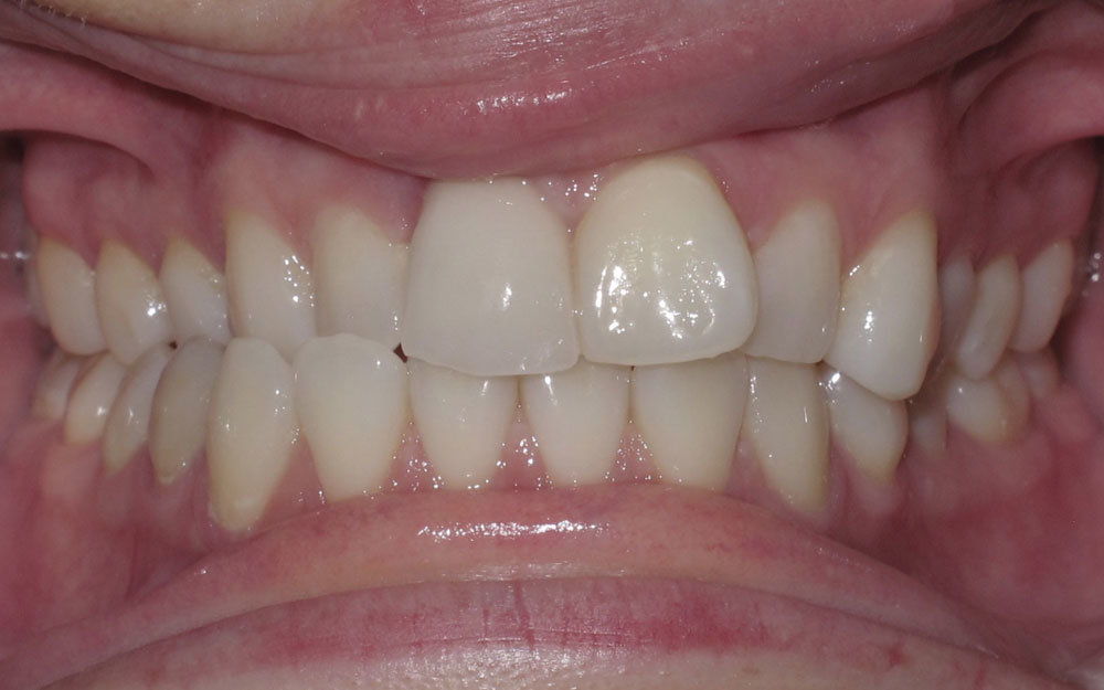 Orthodontics using Orthopulse in Orlando FL